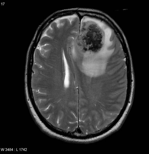 File:Cerebral metastases - renal cell carcinoma (Radiopaedia 5510-7246 Axial T2 4).jpg