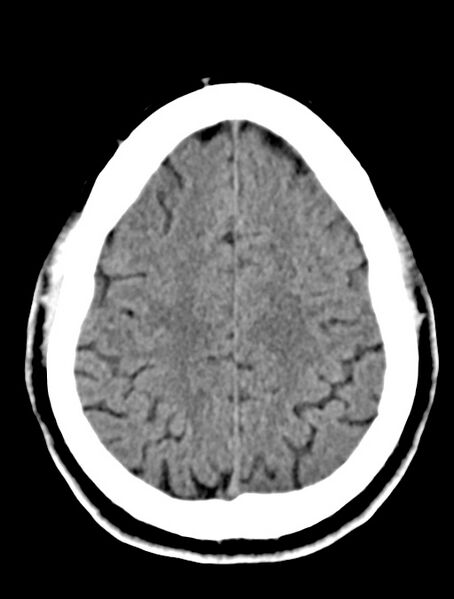 File:Cerebral venous angioma (Radiopaedia 69959-79977 Axial non-contrast 24).jpg