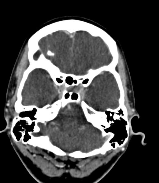 File:Cerebral venous sinus thrombosis (Radiopaedia 59224-66646 Axial C+ delayed 41).jpg