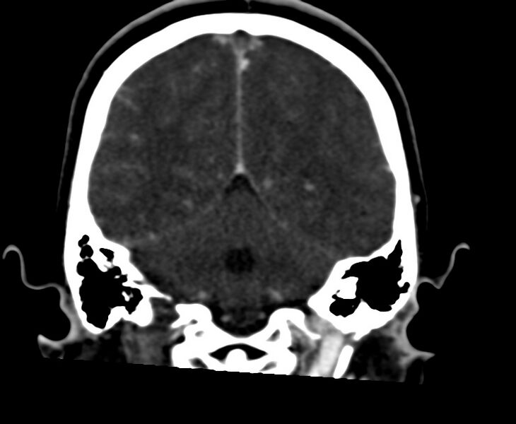 File:Cerebral venous sinus thrombosis (Radiopaedia 59224-66646 Coronal C+ delayed 53).jpg