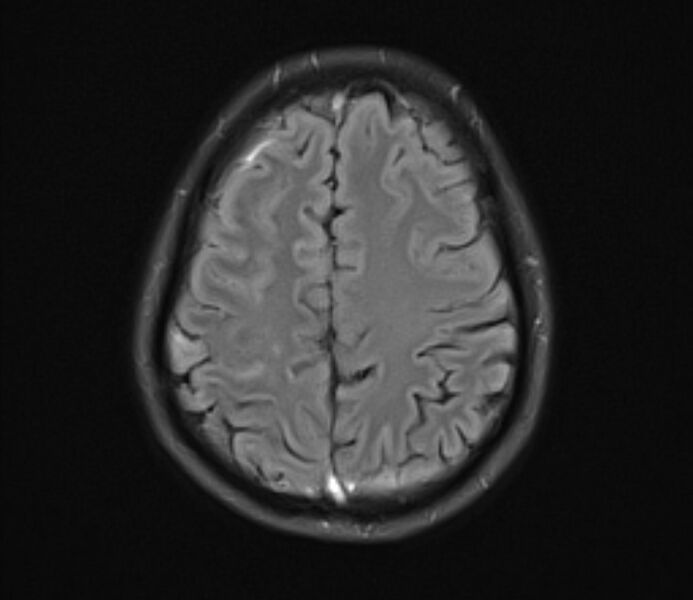 File:Cerebral venous thrombosis (Radiopaedia 71207-81504 Axial FLAIR 20).jpg