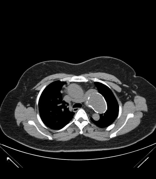 File:Cervical aortic arch with coarctation and aneurysms (Radiopaedia 44035-47552 Axial non-contrast 18).jpg