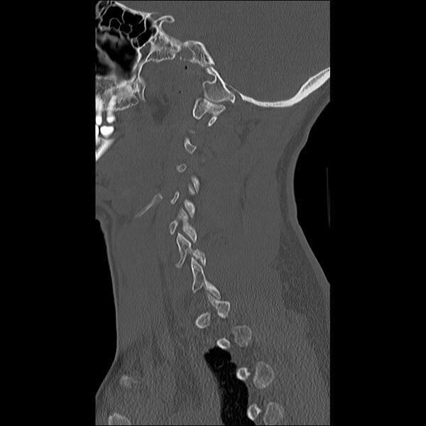 File:Cervical facet fracture and anterior discoligamentous injury (Radiopaedia 32139-33083 Sagittal bone window 31).jpg