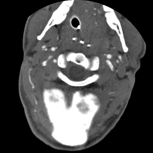File:Cervical spine fractures with vertebral artery dissection (Radiopaedia 32135-33078 D 65).jpg