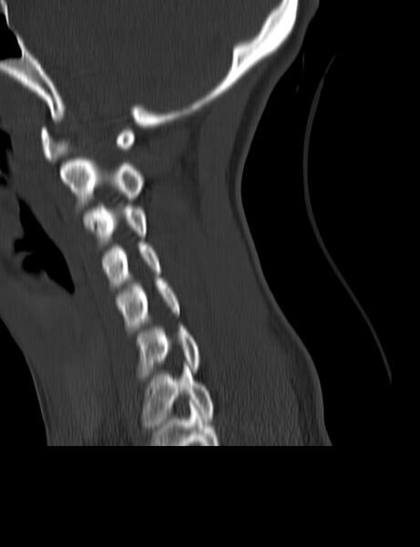 File:Cervical spine posterior ligamentous complex rupture (Radiopaedia 63486-72101 Sagittal bone window 17).jpg