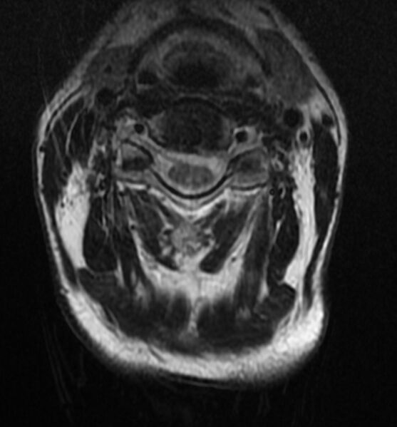 File:Cervical spondylodiscitis (Radiopaedia 81362-95110 Axial T2 5).jpg