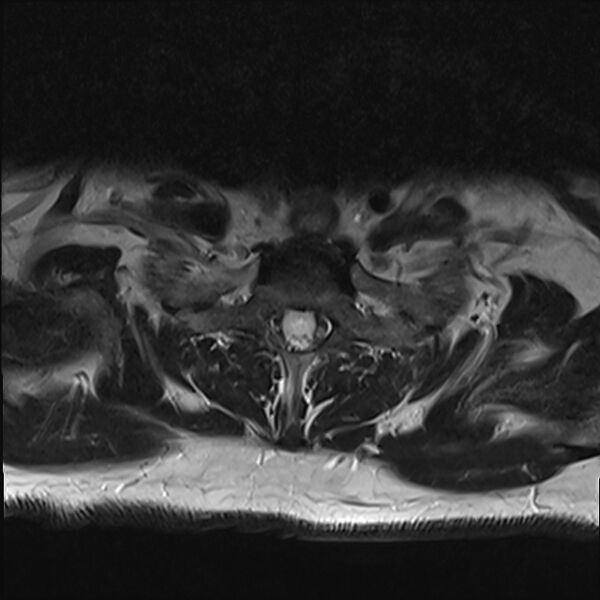 File:Cervical tumor-like myelopathy due to Type V dAVF (Radiopaedia 82461-96604 Axial T2 32).jpg