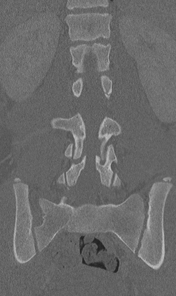 File:Chance fracture (Radiopaedia 40360-42912 Coronal bone window 40).png