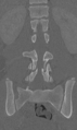 Chance fracture (Radiopaedia 40360-42912 Coronal bone window 40).png