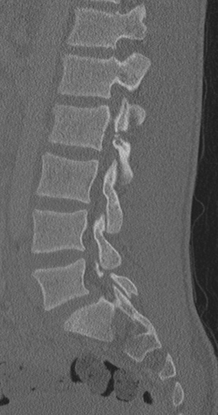 File:Chance fracture (Radiopaedia 40360-42912 Sagittal bone window 43).png