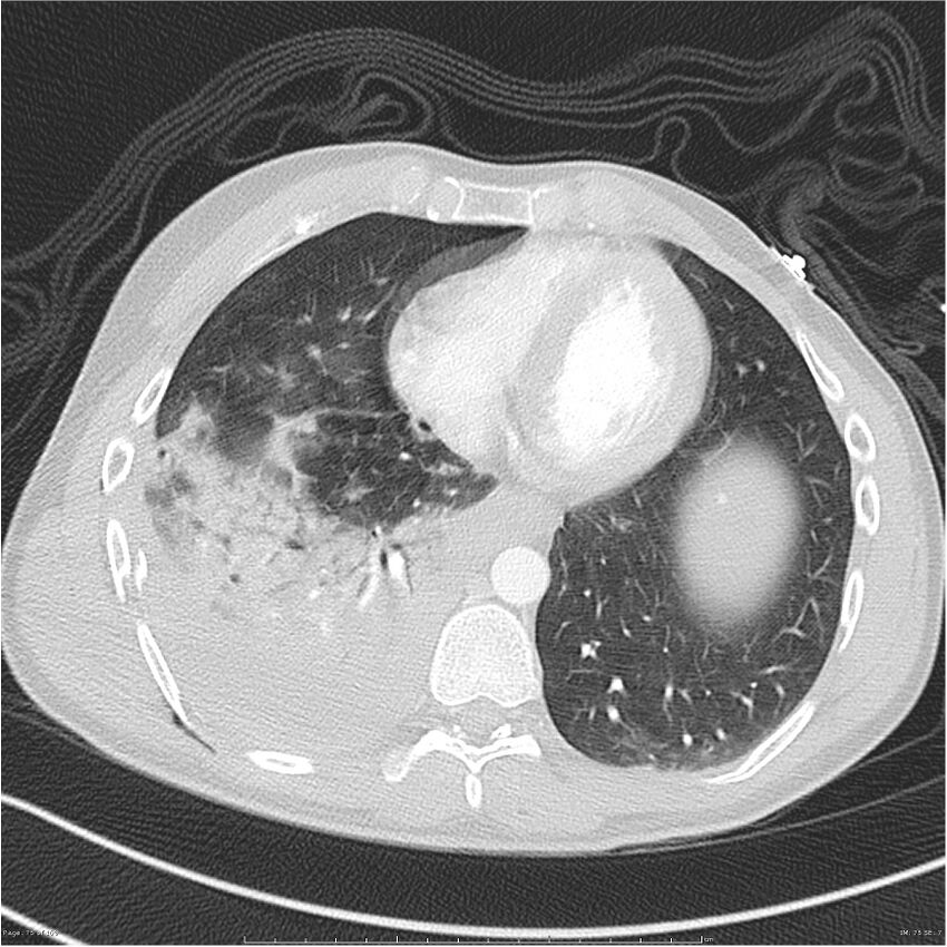Chest and abdomen multi-trauma (Radiopaedia 26294-26425 lung window 75).jpg