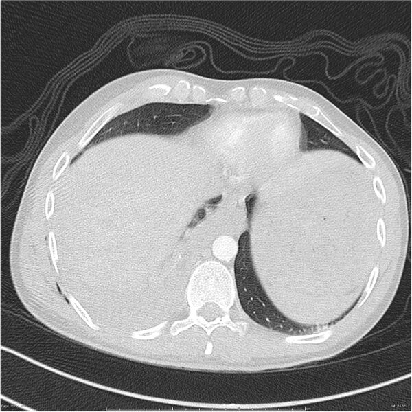 File:Chest and abdomen multi-trauma (Radiopaedia 26294-26425 lung window 84).jpg