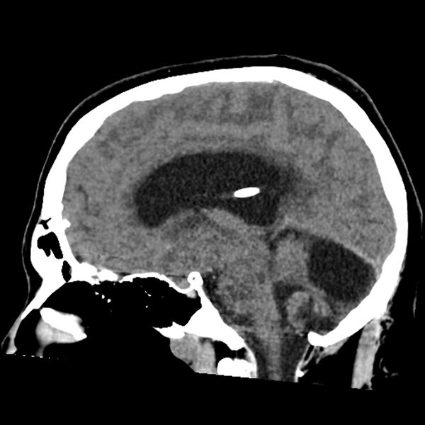 File:Chiasmatic-hypothalamic juvenile pilocytic astrocytoma (Radiopaedia 78533-91237 B 35).jpg