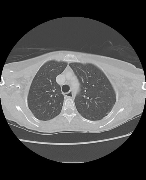 File:Chondrosarcoma (Radiopaedia 79427-92532 Axial lung window 16).jpg