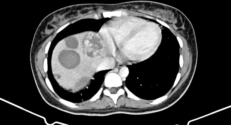 File:Choriocarcinoma liver metastases (Radiopaedia 74768-85766 A 21).jpg
