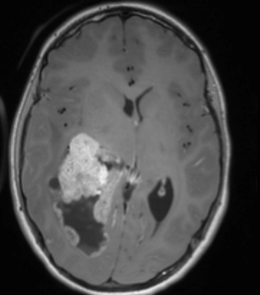 Choroid plexus carcinoma (Radiopaedia 91013-108553 Axial T1 C+ 132).jpg