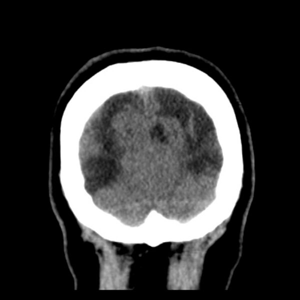 File:Chronic bilateral occipital lobe infarcts (Radiopaedia 31276-31996 Coronal non-contrast 42).jpg