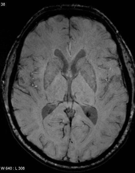File:Chronic lymphocytic inflammation with pontine perivascular enhancement responsive to steroids (CLIPPERS) (Radiopaedia 37520-39374 Axial SWI 37).jpg