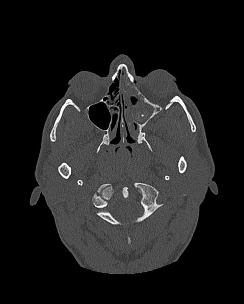 File:Chronic maxillary sinusitis caused by a foreign body (Radiopaedia 58521-65676 Axial bone window 158).jpg