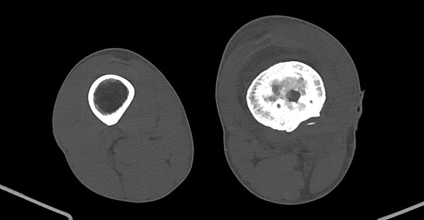 Chronic osteomyelitis (with sequestrum) (Radiopaedia 74813-85822 Axial non-contrast 147).jpg