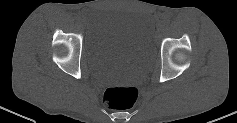 File:Chronic osteomyelitis (with sequestrum) (Radiopaedia 74813-85822 Axial non-contrast 30).jpg