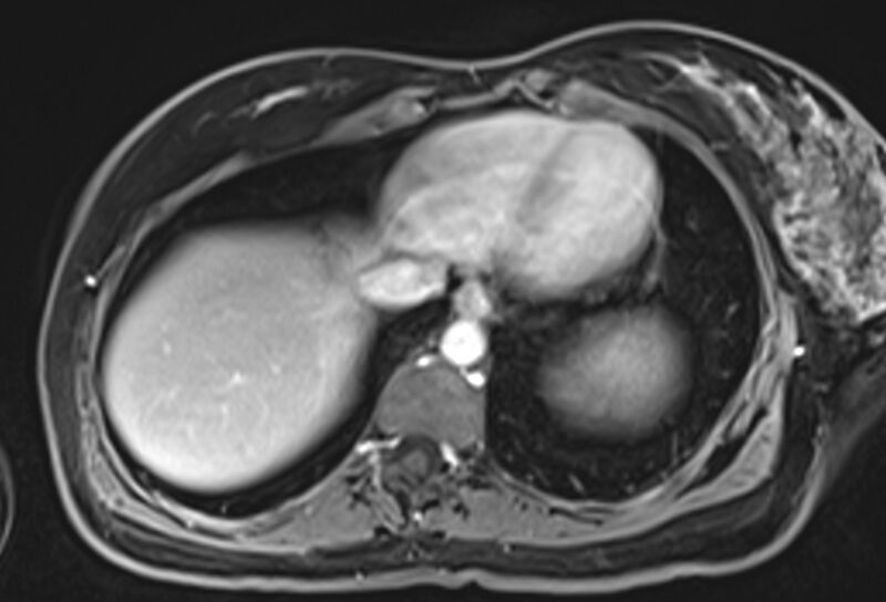 File:Chronic pancreatitis - pancreatic duct calculi (Radiopaedia 71818-82250 Axial T1 C+ fat sat 4).jpg