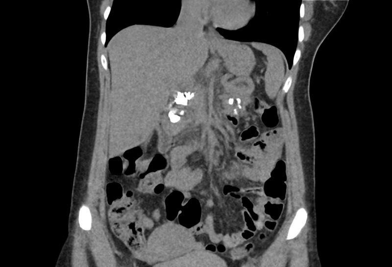 File:Chronic pancreatitis - pancreatic duct calculi (Radiopaedia 71818-82251 Coronal non-contrast 17).jpg