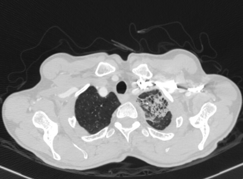 File:Chronic pulmonary embolism with bubbly consolidation (Radiopaedia 91248-108850 Axial lung window 11).jpg