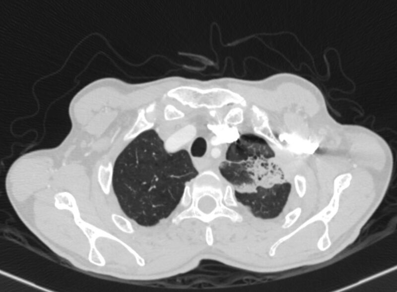 File:Chronic pulmonary embolism with bubbly consolidation (Radiopaedia 91248-108850 Axial lung window 18).jpg
