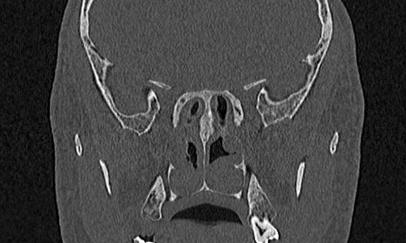 File:Chronic rhinosinusitis (Radiopaedia 65079-74075 Coronal bone window 60).jpg