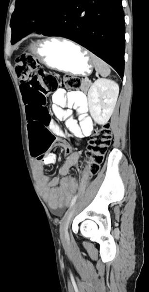 File:Chronic small bowel volvulus (Radiopaedia 75224-86322 C 46).jpg