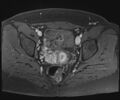 Class II Mullerian duct anomaly- unicornuate uterus with rudimentary horn and non-communicating cavity (Radiopaedia 39441-41755 Axial T1 fat sat 77).jpg