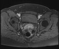 Class II Mullerian duct anomaly- unicornuate uterus with rudimentary horn and non-communicating cavity (Radiopaedia 39441-41755 Axial T1 fat sat 91).jpg