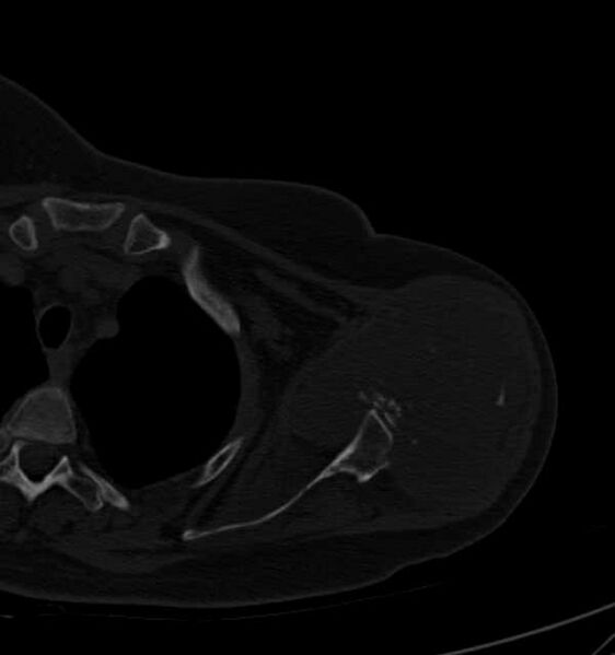 File:Clear cell chondrosarcoma - humerus (Radiopaedia 63104-71612 Axial bone window 40).jpg