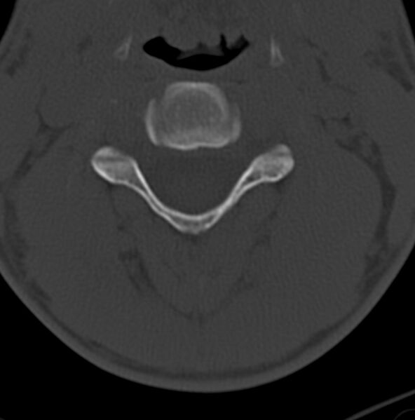 File:Cleft of the posterior arch of C1 mimicking fracture (Radiopaedia 40201-42721 Axial bone window 1).jpg
