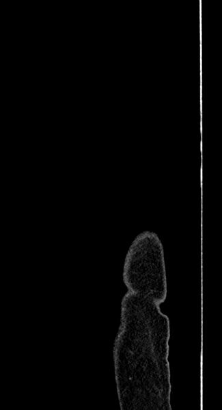 File:Closed loop small bowel obstruction - adhesive band with a C-shaped loop (Radiopaedia 83832-99018 C 7).jpg