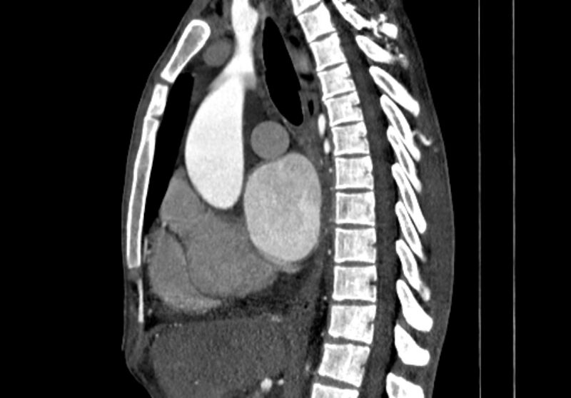 File:Coarctation of aorta with aortic valve stenosis (Radiopaedia 70463-80574 B 49).jpg