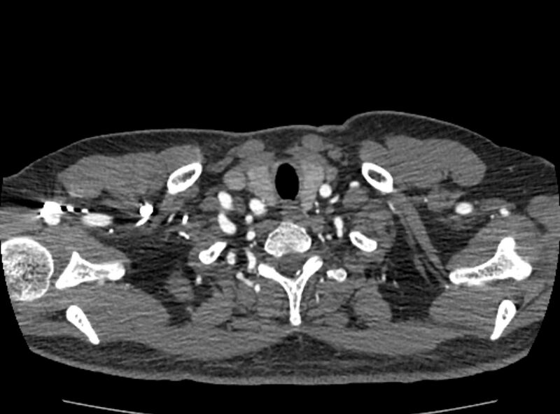 File:Coarctation of the aorta (Radiopaedia 53363-59343 A 7).jpg