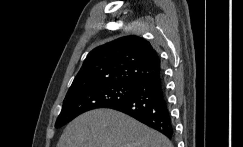File:Coarctation of the aorta (Radiopaedia 53363-59343 B 1).jpg