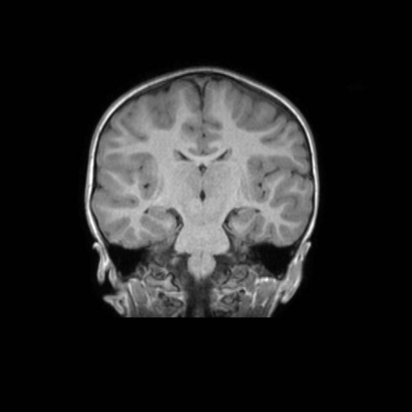 File:Cochlear nerve aplasia - unilateral (Radiopaedia 87910-104413 Coronal T1 30).jpg