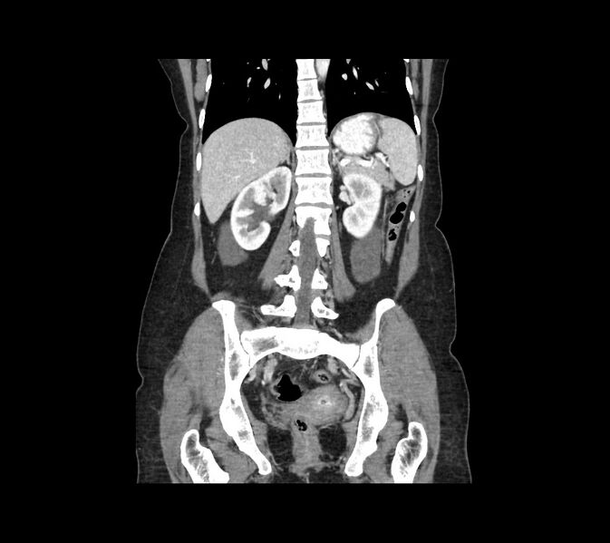 File:Cocoon abdomen with possible tubo-ovarian abscess (Radiopaedia 46235-50636 B 36).jpg