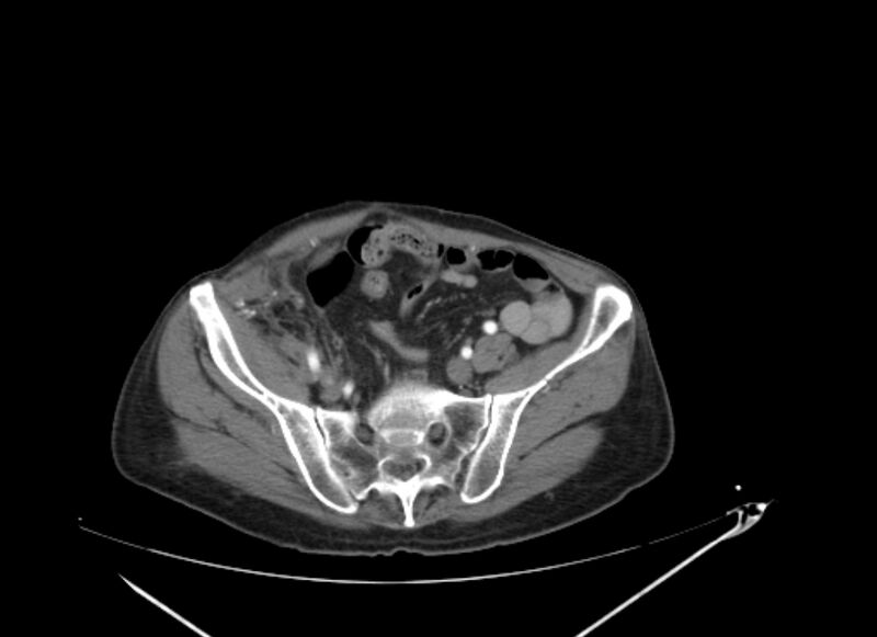 File:Colon cancer mimicking renal cell carcinoma (Radiopaedia 28986-29335 B 60).jpg