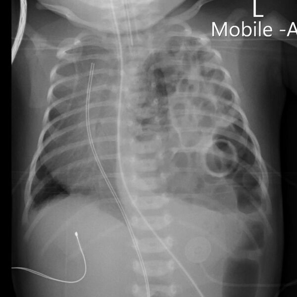 File:Diaphragmatic hernia (Radiopaedia 22108).jpg
