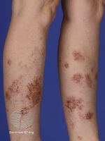 Discoid eczema (DermNet NZ discoid-eczema-001).jpg