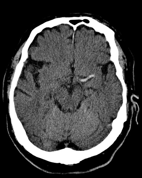 File:Hyperdense middle cerebral artery sign (Radiopaedia 7150).jpg