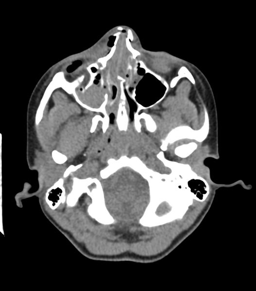 File:Nasoorbitoethmoid fracture (Radiopaedia 90044-107205 Axial 124).jpg
