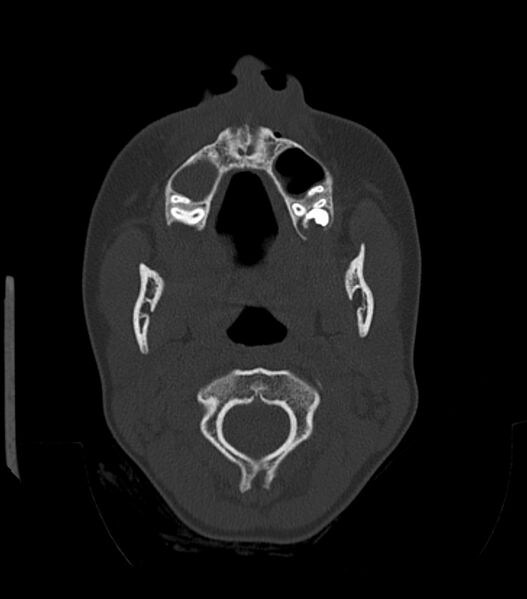 File:Nasoorbitoethmoid fracture (Radiopaedia 90044-107205 Axial bone window 49).jpg