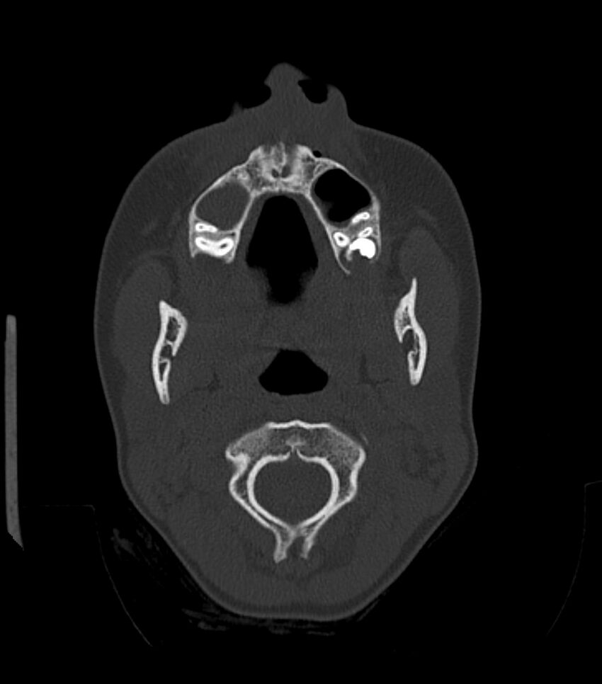 Nasoorbitoethmoid fracture (Radiopaedia 90044-107205 Axial bone window 49).jpg