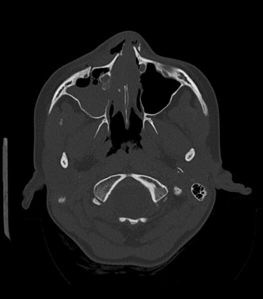 File:Nasoorbitoethmoid fracture (Radiopaedia 90044-107205 Axial bone window 65).jpg