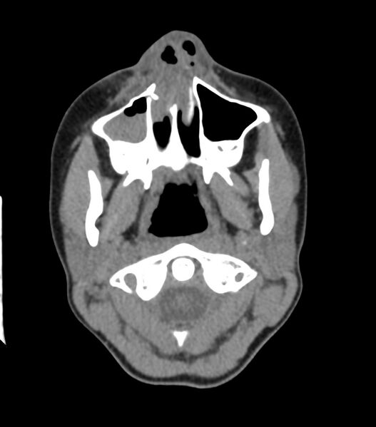 File:Nasoorbitoethmoid fracture (Radiopaedia 90044-107205 Axial non-contrast 109).jpg